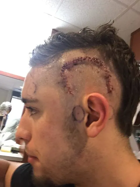 The incision after the first surgery