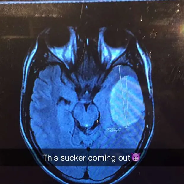 MRI scan
